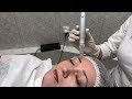 Микронидлинг. Микронидлинг  на аппарате derma pen.