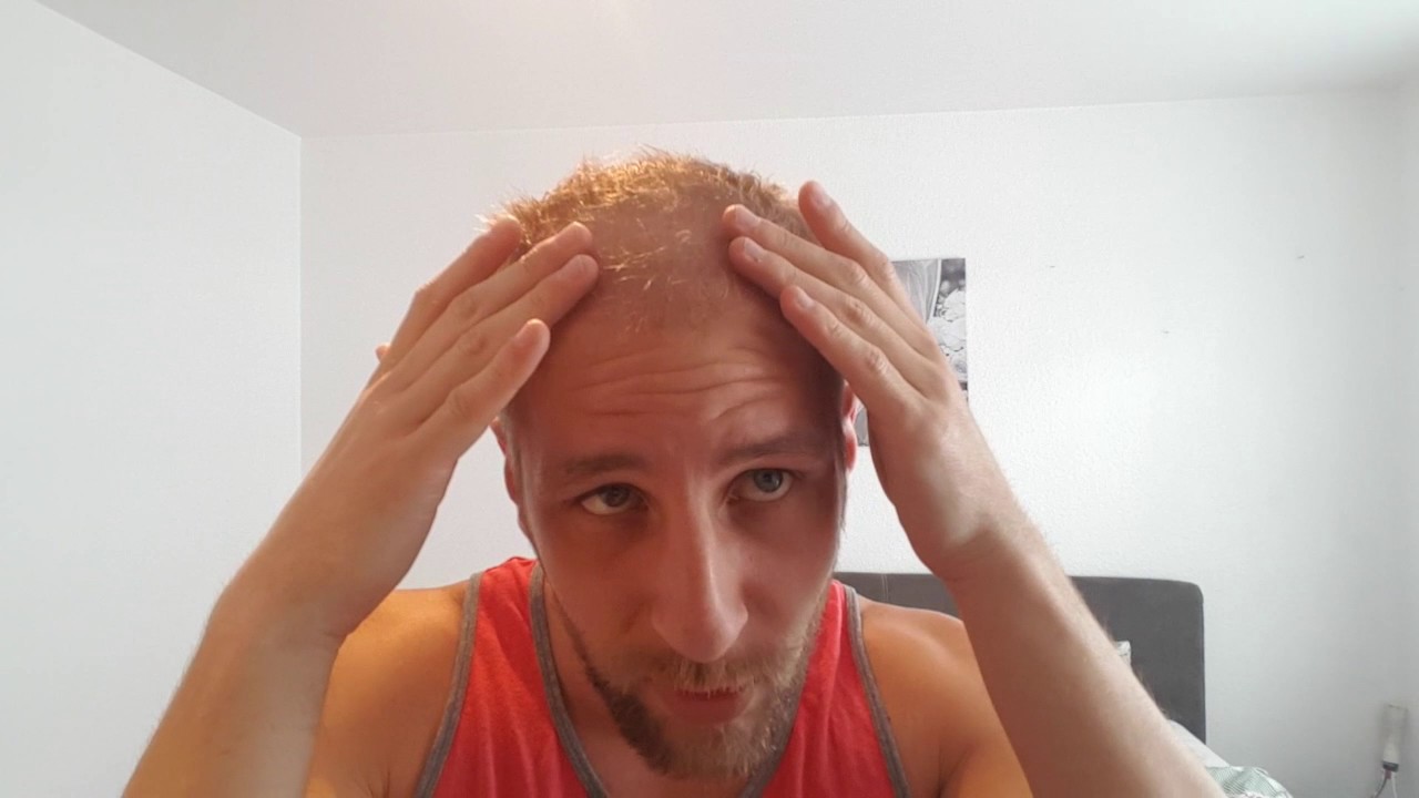 alle haare weg 2 monate nach der op