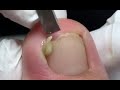 Suppurative nail treatment