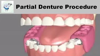 Removable Partial Dentures Steps