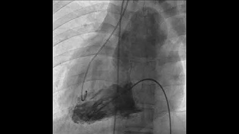 SS/DC - CTGA VSD - LV ANGIOGRAM