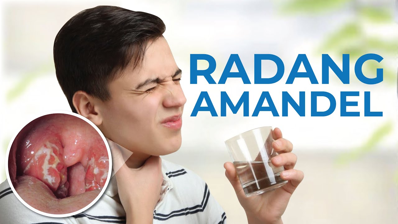 Kena Radang Amandel? Simak 7 Cara Mengobatinya, Bisa di Rumah Kok