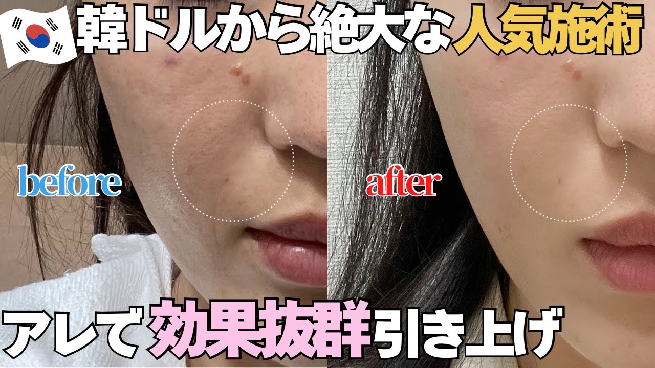 【1回でほうれい線消えた】ダウンタイム無し、一回で若返り人気のリフティングがめちゃ効果出た！短い渡韓にもおすすめクリニック紹介！