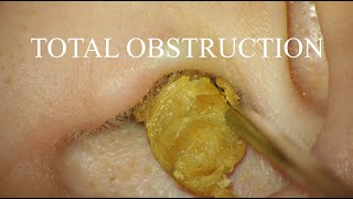 TOTAL OBSTRUCTION : EAR WAX REMOVAL : 4K/HD Resimi