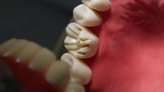 Full Zirconia Crown Prep #3 (rounded shoulder)  Dr. Mark R. Taylor