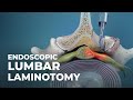 Endoscopic lumbar laminotomy atlanticspinecenter