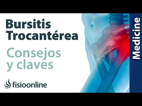 Video: Cómo hacer frente a la bursitis trocantérea: 13 pasos (con imágenes)