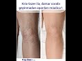 kriolazer kriosklero cryolaser cryoscleroterapy ClaCs Azerbaijan Baku Center kriolazer mərkəzi Bakı