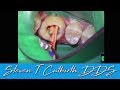 Endo of 5 Canal Molar - Dental Minute with Steven T. Cutbirth, DDS
