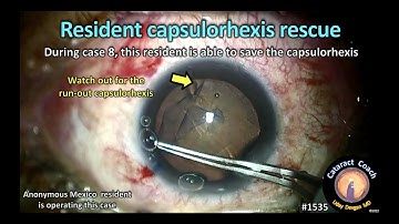 CataractCoach 1535: resident capsulorhexis rescue