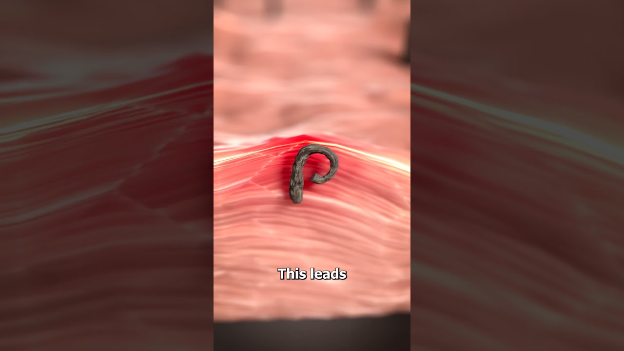 What Is An Ingrown Hair 