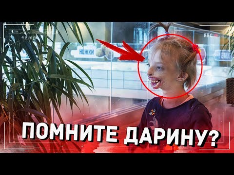 Мать упала при виде её! КАК сейчас выглядит Дарина Шпенглер которая родилась БЕЗ губ и подбородка..?