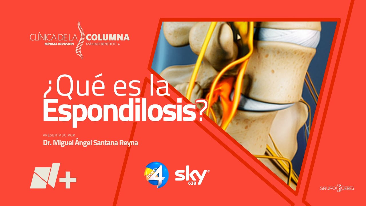 ¿Qué es la Espondilosis? - Clínica de la Columna