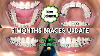 5 MONTHS BRACES UPDATE | Broken Wires, Staining, Poor Hygiene And I Still Haven&#39;t Enjoyed A Meal 🥲