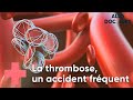 Thrombose : toutes vos questions - Allo Docteurs