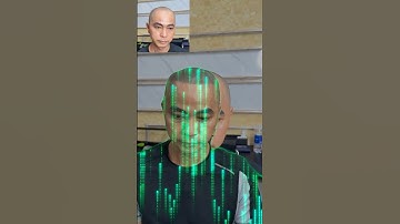 Tại sao chữa hói không khỏi, hói chữ m là gì? Nguyên nhân hói??!! #hói_đầu