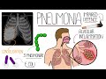 Pneumonia Explained Clearly (Includes Community &amp; Hospital Acquired)