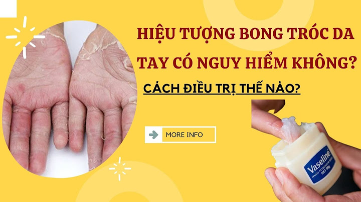 Nguyên nhân tay bị tróc da