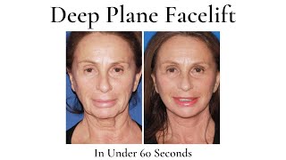 The Deep Plane Facelift (In Under 60 Seconds)