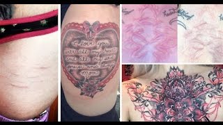 TATTOOING OVER SCARS.