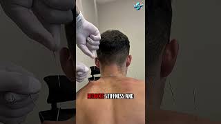 Dry Needling Therapy Explained | Relieve Muscle Pain Fast! 💆♂️💉"#viral #shorts #bangladesh