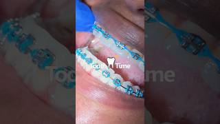 Why do we reposition brackets?🦷🔧 Tooth Time Family Dentistry