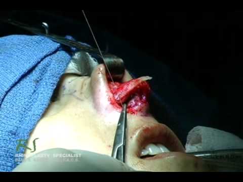Video thumbnail: OR Video Footage: Correcting a Nose Job | Trusted with Noses Worldwide™ | Dr. Paul Nassif · NassifMD®