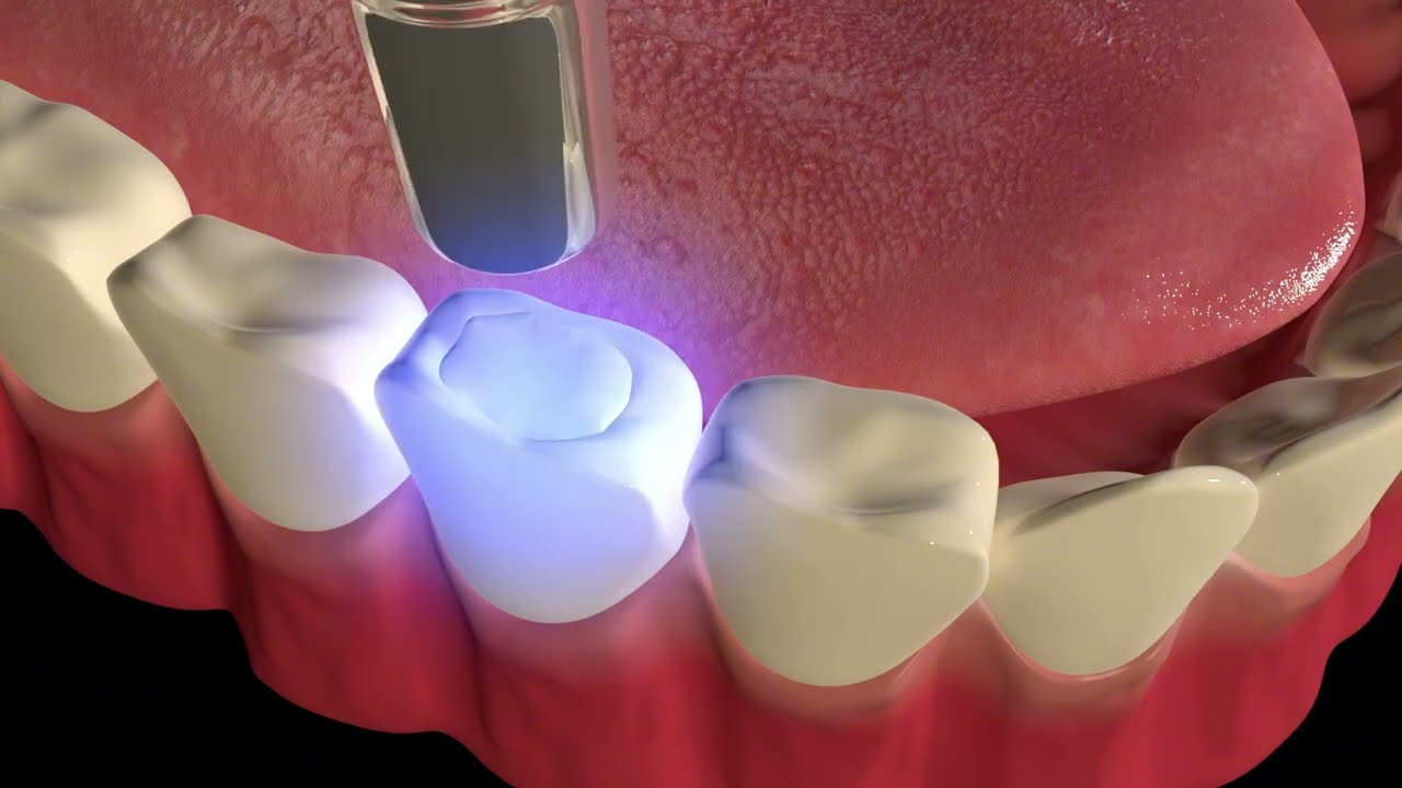 Removing Dental Caries: Step-by-Step Cavity Treatment (Animation)