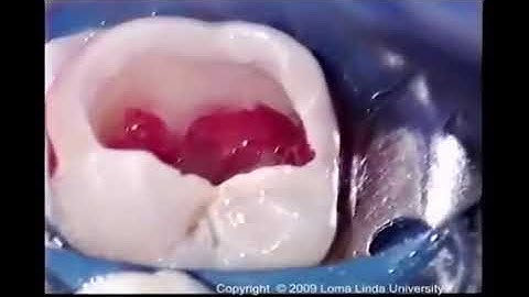 Apexogenesis  التخلق (التولد الذروي)  MTA