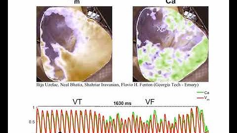 Researchers map rotating spiral waves in live human hearts