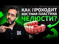 Все о костной пластике челюсти при имплантанции зубов простыми словами за 11 минут