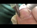 Ingrown toenail