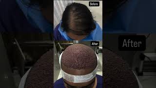Hair transplantation journey