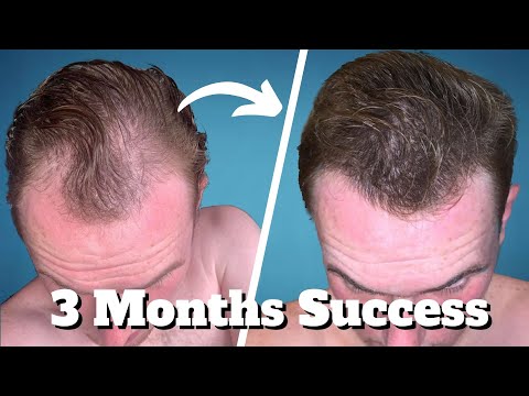 TOPICAL FINASTERIDE: The GREATEST Underrated Hair Remedy?