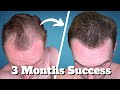 Topical finasteride the greatest underrated hair remedy