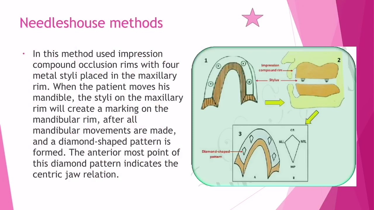 2-09 Prosthodontics, Horizontal relations.