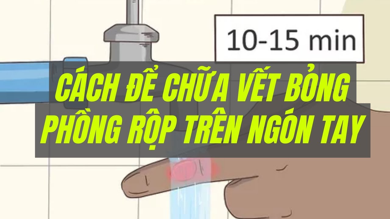 Cách để chữa vết bỏng phồng rộp trên ngón tay | WikiHow Tiếng Việt ...