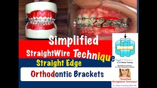 Simplified Straight-wire Technique Orthodontic Course by Gilbert Cabansag