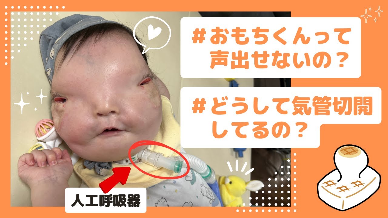 おもちくんの声が出ない理由。気管切開について【1歳4ヶ月/医療的ケア