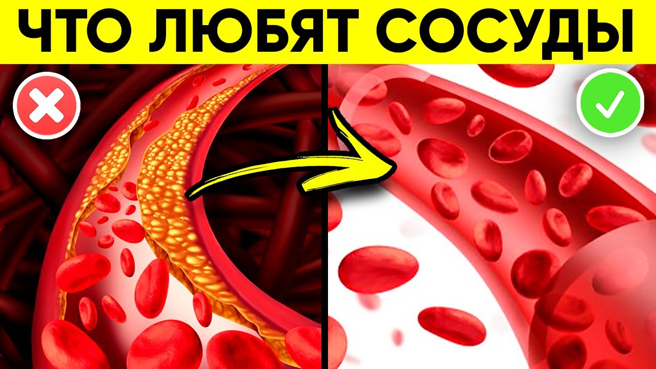 Вот Что Укрепляет Сосуды! (Как Улучшить Кровообращение и Защититься От Атеросклероза?)