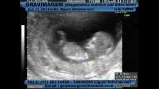 Gravimagem 10936 Ultrom Em Gravidez Com 12 Semanas