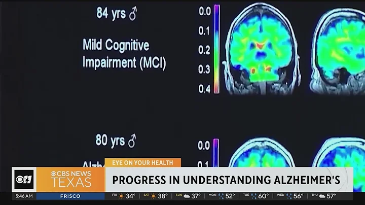 Doctors say they're one step closer to understanding Alzheimer's