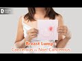 Breast Lumps:Cancerous vs Non-Cancerous |Are all lumps dangerous?-Dr.Nanda Rajneesh| Doctors&#39; Circle