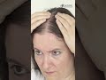 Stop Treating Skin Problems on the Surface | Acne, Hair Fall & Skin Signs Explained by Dermatologist