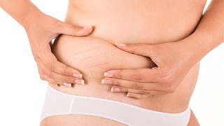 Does a Tummy Tuck Remove Stretch Marks? | Plastic Surgery Profile