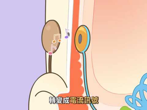 聽力小宇宙 什麼是人工電子耳017