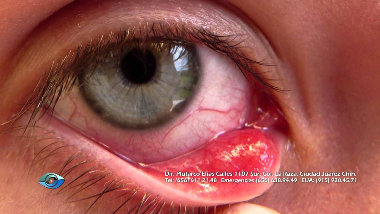Me Salio Una Carnosidad En El Ojo