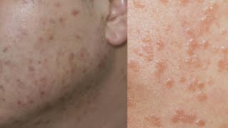 여드름 짜면 x되는 이유 (여드름 없애는 방법)