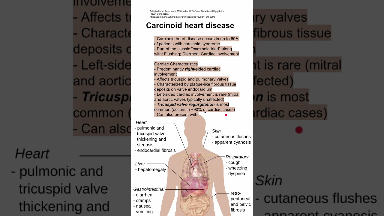 Carcinoid heart disease