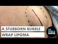 A Stubborn Bubble Wrap Lipoma